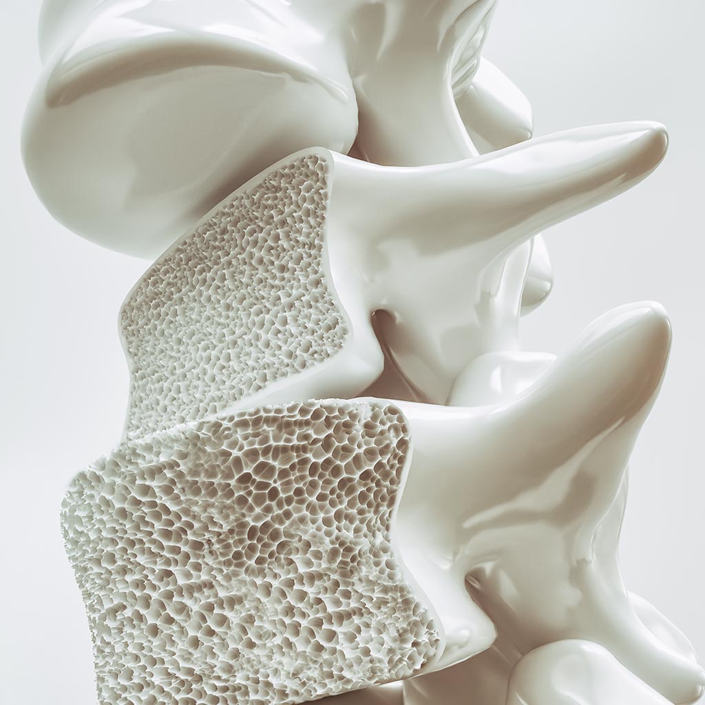 Osteoporose erkennen